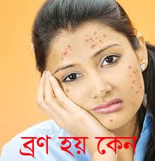 আমাদের মুখে ব্রণ হয় কেন