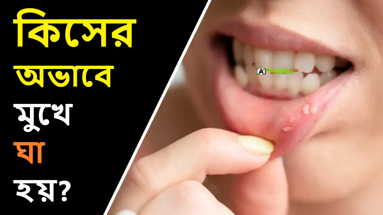 কিসের অভাবে মুখে ঘা হয়